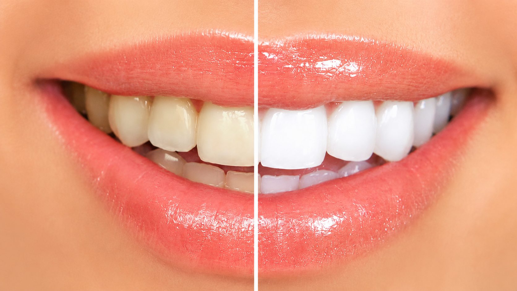 White Teeth Treatment